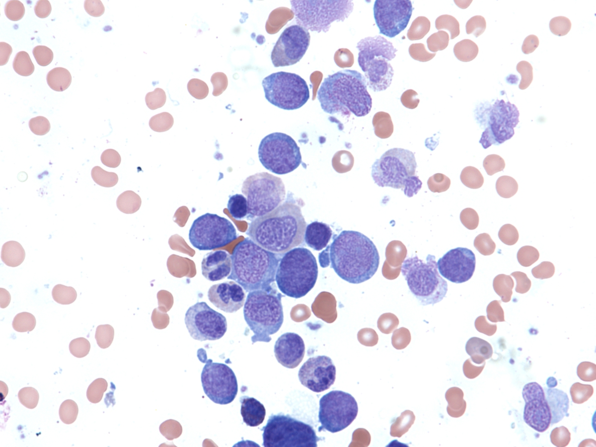 bone marrow aspirate with marked myeloid dysplasia